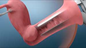 Pap smear alias pap test yaitu metode pemeriksaan yang dilakukan guna mendeteksi ada atau tidaknya kanker leher rahim atau kanker serviks. Pap Test Youtube