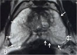 The prostate is a gland in the male reproductive system. Peripheral Zone Enlargement A Newly Described Entity On Mri Medrxiv