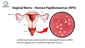 Image result for human papillomavirus symptoms