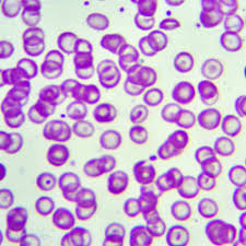 Nei soggetti affetti da talassemia, la forma mutata di emoglobina provoca la graduale ma inesorabile distruzione dei globuli. Talassemia Malattie Rare Di Origine Ereditaria Issalute