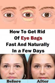 Pin By Eyebags Baking Soda On Dark Eye Bags Eye Bags Under Eye Bags Undereye