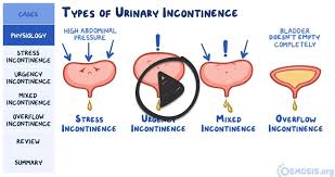Image result for Overflow Incontinence