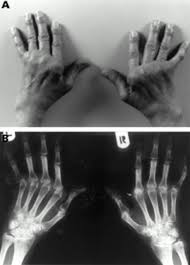 Lupus made me feel like my bone marrow hurt. Deforming Arthropathy Or Lupus And Rhupus Hands In Systemic Lupus Erythematosus Annals Of The Rheumatic Diseases