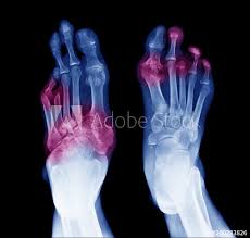 Diabetic neuropathy is nerve damage that can occur in people with diabetes. Symptoms And Warning Signs For Diabetic Neuropathy