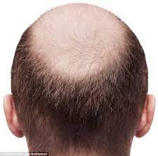 My hair grows at about the average speed.hai. Bald Now There S A Jab To Make Hair Grow Back Daily Mail Online