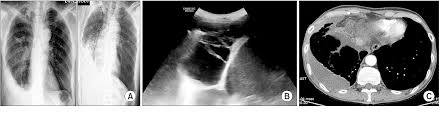 Pleural effusions may result from pleural, parenchymal, or extrapulmonary disease. Pdf Loculated Tuberculous Pleural Effusion Easily Identifiable And Clinically Useful Predictor Of Positive Mycobacterial Culture From Pleural Fluid Semantic Scholar