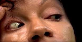 Actress Damages Eyes For The Sake Of Beauty Eye For Beauty Best Eye Drops Eyes