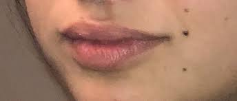 Since its founding by husband and wife team leon and barbara prete almost twenty years ago, aac has been committed to offering the latest services and top technology in hair removal, cosmetic skin rejuvenation, body sculpting. Will Laser Hair Removal Affect A Dark Mole Photo