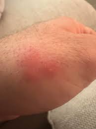 Image result for ant bite