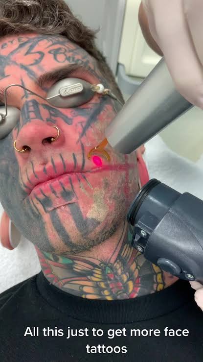 Tattoo Laser Removal Experience: My Sucky Journey