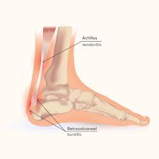 Shop our specials today · dedicated professionals Retrocalcaneal Bursitis Causes Symptoms Treatment