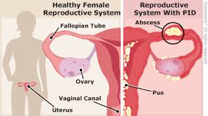 Not all women with pid have noticeable symptoms. Pelvic Inflammatory Disease Pid