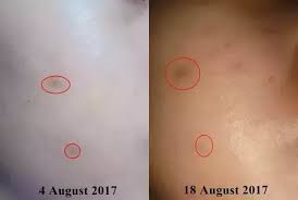 In five minutes, the person had vacuumed their entire face, and then the bruises slowly started to pop up. Why Does My Face Bruise So Easily When I Squeeze It Squeezing Pimple Quora