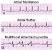 Atrial Tachycardia Ecg Strip