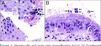 A synthesizer of microbial cellulose, various members of the genus are human flora and may be found in the skin and. Pdf Sarcina Ventriculi As An Unknown Culprit For Esophageal Stricturing Semantic Scholar