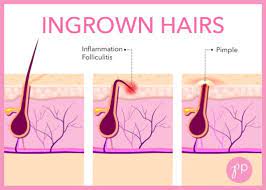 What does an ingrown hair but ingrown hair can affect anyone who removes hair by shaving, tweezing or waxing. How To Remove Scars From Ingrown Hairs Quora