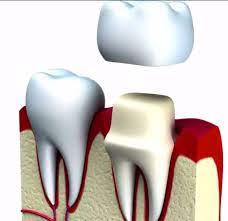 It can be difficult to determine whether you have a cavity. Detecting Tooth Decay Under Crowns Elsinore Smiles