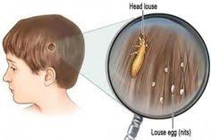 как избавиться от вшей в домашних условиях за 1 день Pin On Nado Poprobovat