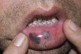 Contact your healthcare professional for an appointment. Diagnosis Of Oral Pigmentations And Malignant Transformations Sciencedirect