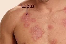 Nursing Paper Example on Lupus Erythematosus [SOLVED]