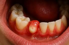 Image result for Periodontal Abscess