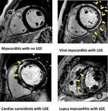 Pericarditis is inflammation of the pericardium (the fibrous sac surrounding the heart). The Patterns Of Late Gadolinium Enhancement In Various Forms Of Download Scientific Diagram
