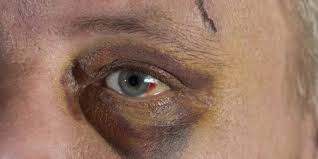 Blaues Auge Ursachen Verlauf Und Wirksame Hausmittel Heilpraxis