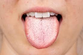 Image result for Candidiasis
