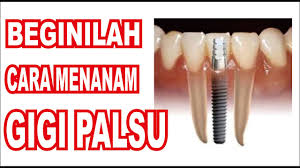 Kami senaraikan klinik dan doktor gigi di malaysia yang diiktirafkan oleh kementerian kesihatan malaysia dan disahkan oleh erufu care team. Beginilah Cara Menanam Gigi Palsu Youtube