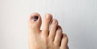 Rupanya, ada beberapa pemicu jari kuku memiliki warna kehitaman. Kuku Kaki Berwarna Hitam Ini Gangguan Kesehatan Dialami Tubuh Okezone Lifestyle