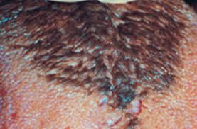 Image result for black hairy tongue symptoms