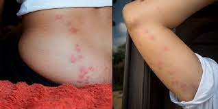 Bed bug bites usually cause itchy welts. Bed Bug Bites Pictures Symptoms What Do Bed Bug Bites Look Like