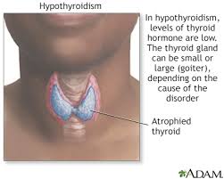 Cancer cells aggressively compete for nourishment with normal cells. Hypothyroidism Underactive Thyroid Symptoms And Causes