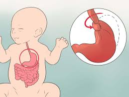 Image result for Pediatric Reflux