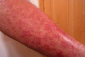 Psoriasis is a complex, chronic, multifactorial, inflammatory disease that involves hyperproliferation of the keratinocytes in the epidermis, with an increase in the epidermal cell turnover rate (see the image. Psoriase Pode Comprometer A Qualidade De Vida Do Paciente Saude Debate