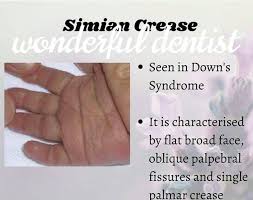 Nov 21, 2019 · stpc or other similar palm crease patterns can help your healthcare provider identify a few disorders, including: Wonderful Doctor Posts Facebook