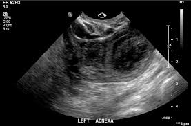 Image result for corpus luteum sonography)