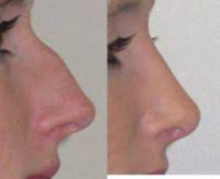 Dr Jag Chana Rhinoplasty Reviews Rhinoplasty Cost Pics Reviews Q A