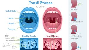 When cancer invades in this area it can lead to coughing, a sore throat and voice changes. Tonsil Stones Causes Symptoms Treatment Prevention Jefferson Dental Orthodontics