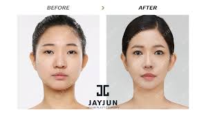 Pin On Eyelid Surgery