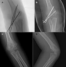 Image result for Lateral Condyle Fracture