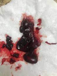 Maybe you would like to learn more about one of these? Pls Help Is This A Blood Clot Or Miscarriage Sorry Tmi December 2020 Babies Forums What To Expect