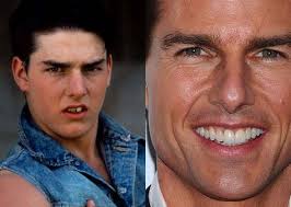 9 Celebrity Smiles Before & After ideas to save today