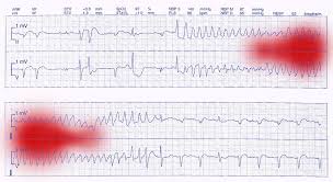 Even in the absence of ecg changes indicating myocardial ischemia. Ecg Trace Of A Heart Attack Photograph By Doncaster And Bassetlaw Hospitals Science Photo Library