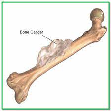 Do you believe your eating habits to be healthy? Bone Cancer