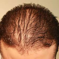This form of hair loss follows the typical horseshoe pattern for men and christmas tree pattern for women. Best Hair Loss Treatment In Mumbai Alopecia Treatment