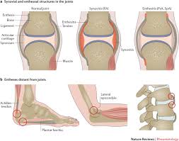 Check out what may be causing it and exactly what you can. Enthesitis From Pathophysiology To Treatment Nature Reviews Rheumatology