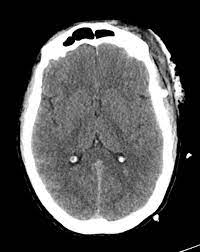 Diffuse Axonal Injury Grade Iii Radiology Case Radiopaedia Org