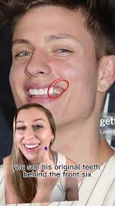 Dont do what Matt Rife did in his dental journey! 🚫🦷‼️ #veneers  #mattrifecomedy #veneertips