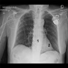 Il pacemaker può essere temporaneo o permanente, e le versioni moderne sono in grado di rilevare i segni vitali del paziente. Pacemaker Cardiaci Disturbi Dell Apparato Cardiovascolare Manuali Msd Edizione Professionisti